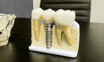 Modelo de coroa sobre implante dentário